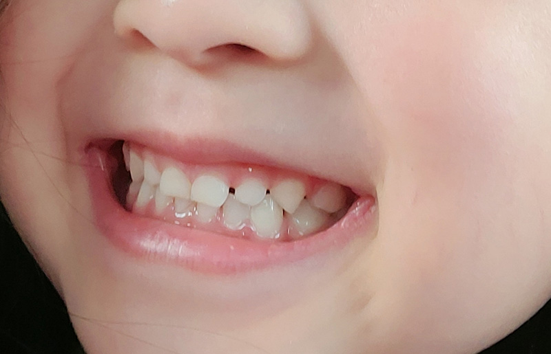 ガタガタの歯並び（叢生）とは？