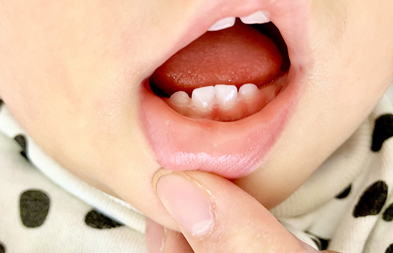 3歳〜5歳（乳歯列期）